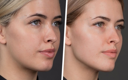 Facial Contouring with Fillers: Which Areas Can Be Corrected?